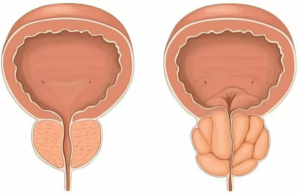 Zdrowa prostata i zapalenie gruczołu krokowego