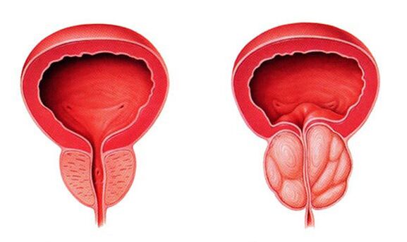 Normalna i zapalona prostata (zapalenie gruczołu krokowego)
