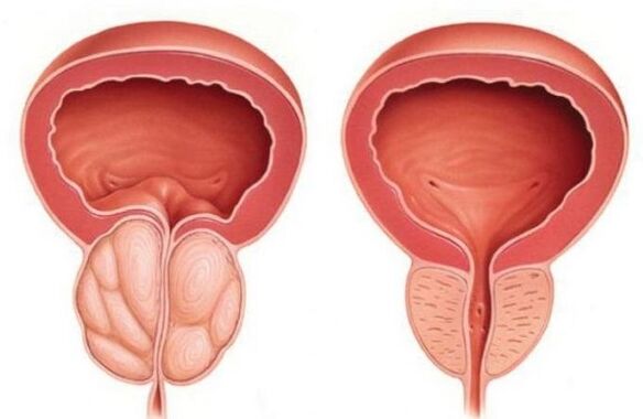 normalna i powiększona prostata z zapaleniem gruczołu krokowego